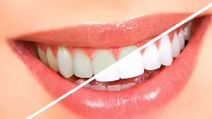 Gums Treatment in Lahore