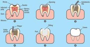 Teeth Scaling and Polishing in Lahore