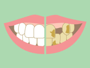 Effects Of Smoking On Teeth